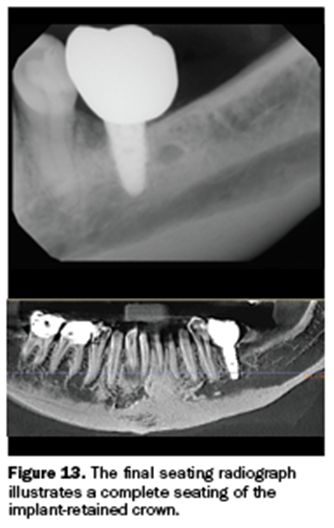 guided implant surgery