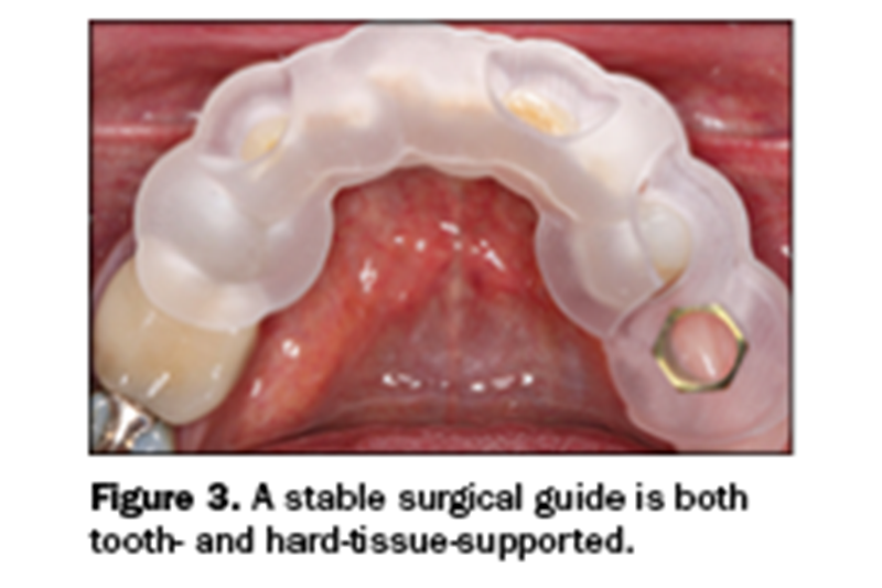 guided implant surgery