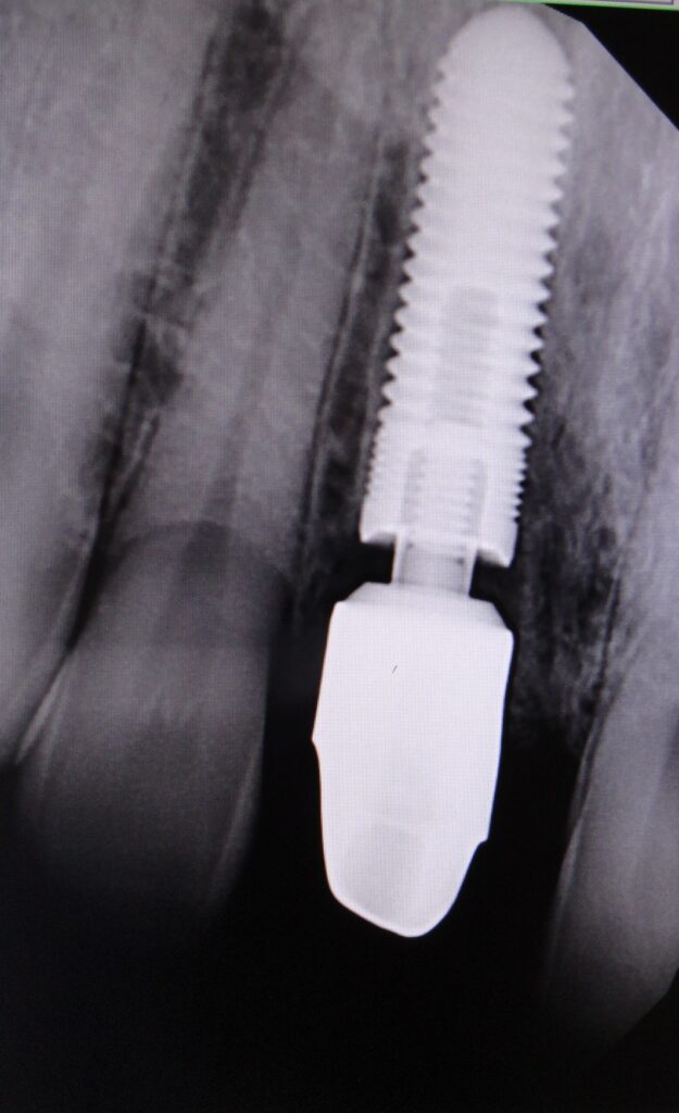 immediate implant placement