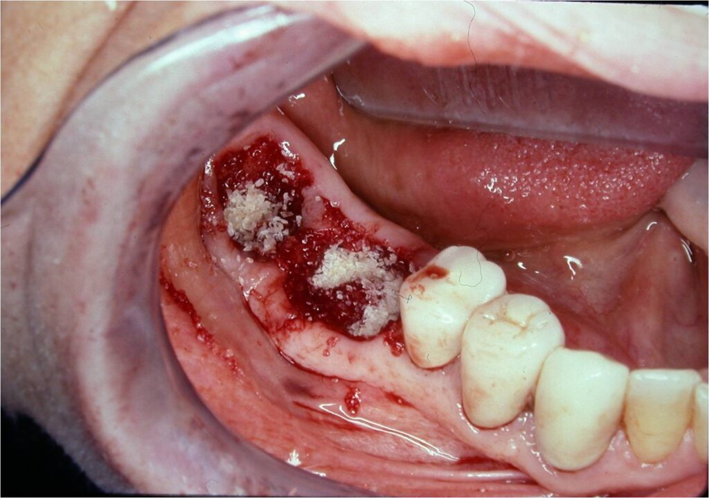 successful implant integration