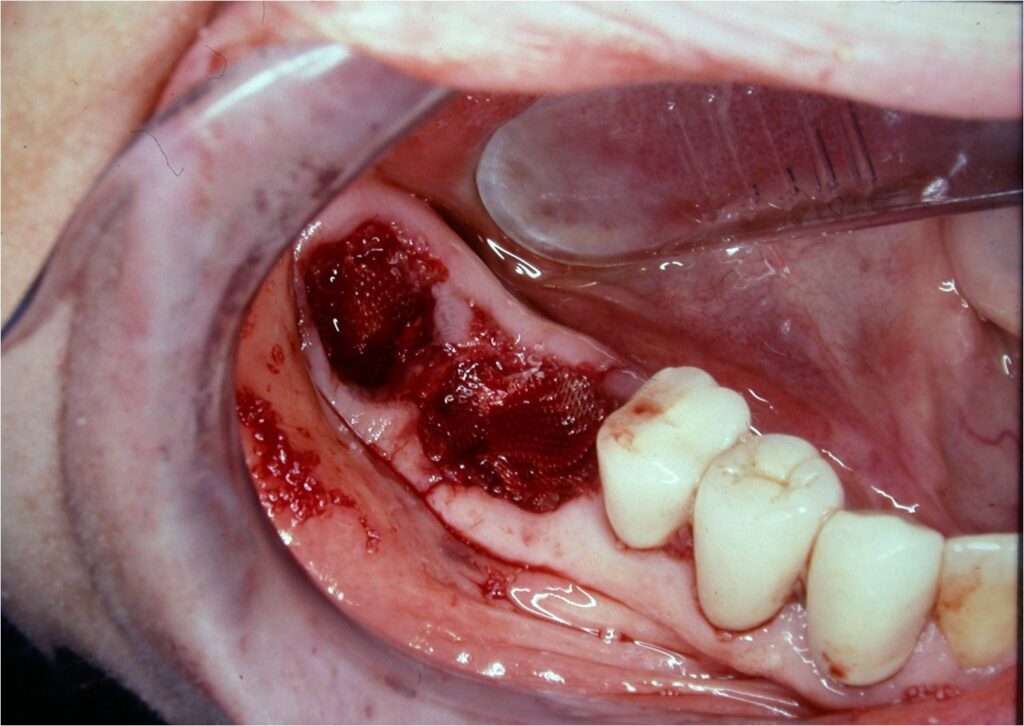 successful implant integration