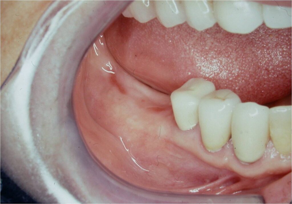 successful implant integration