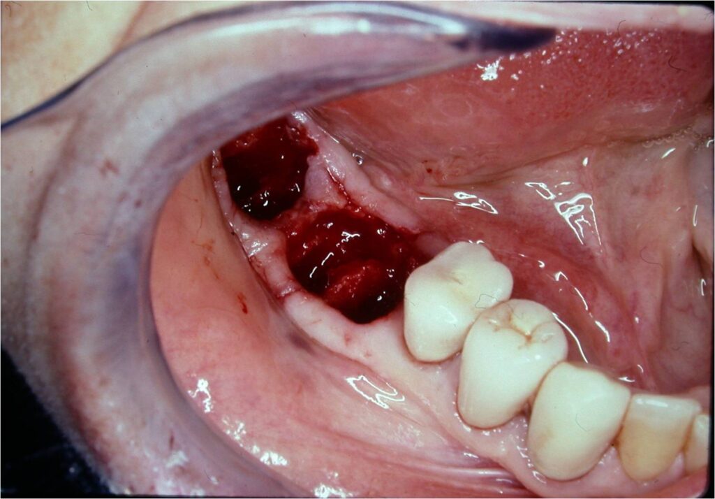 successful implant integration