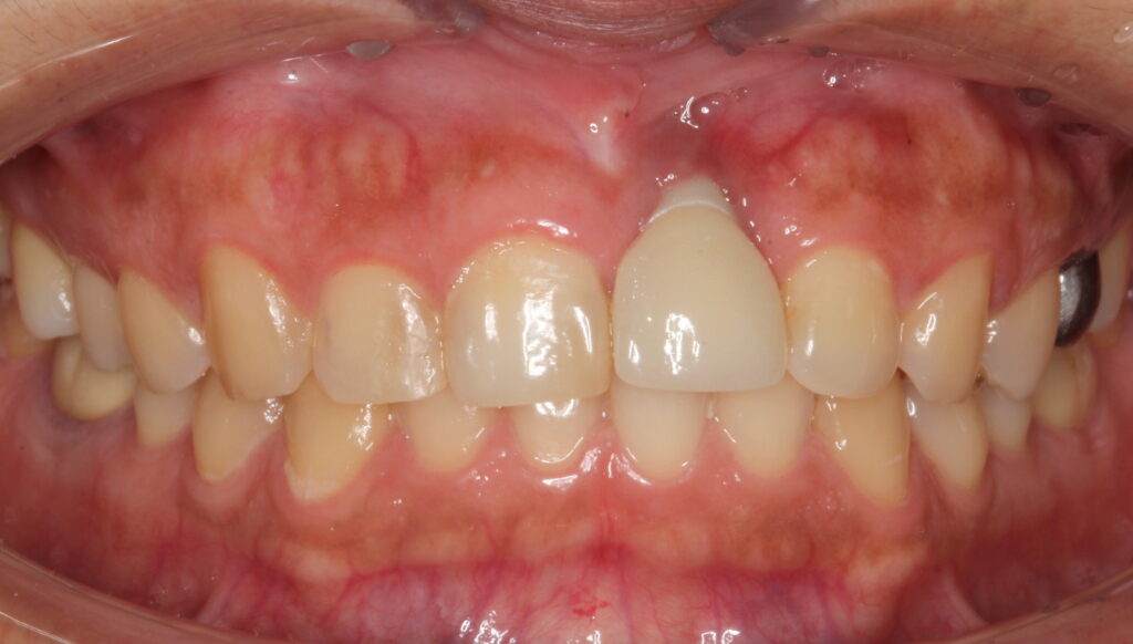 peri-implantitus