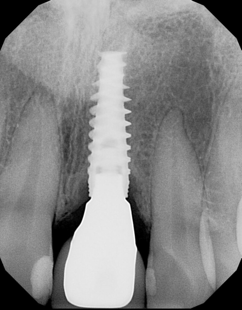 peri-implantitus