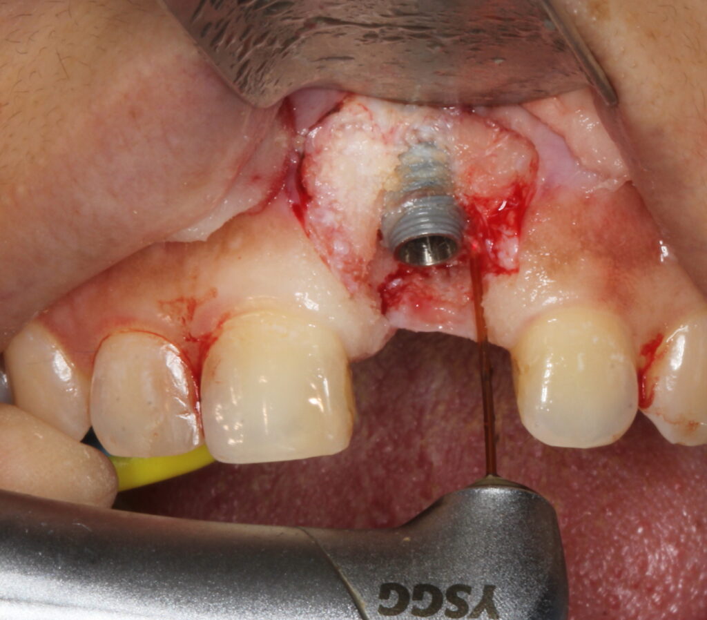 peri-implantitus