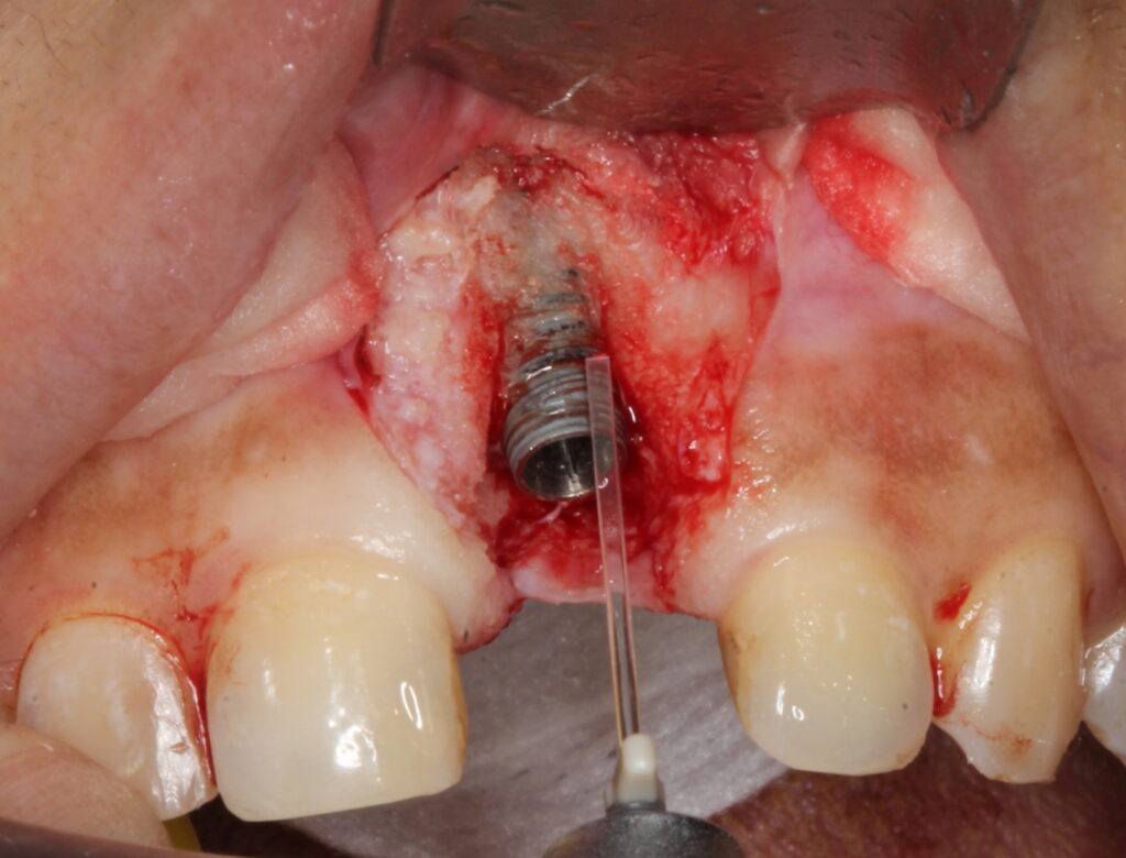peri-implantitus
