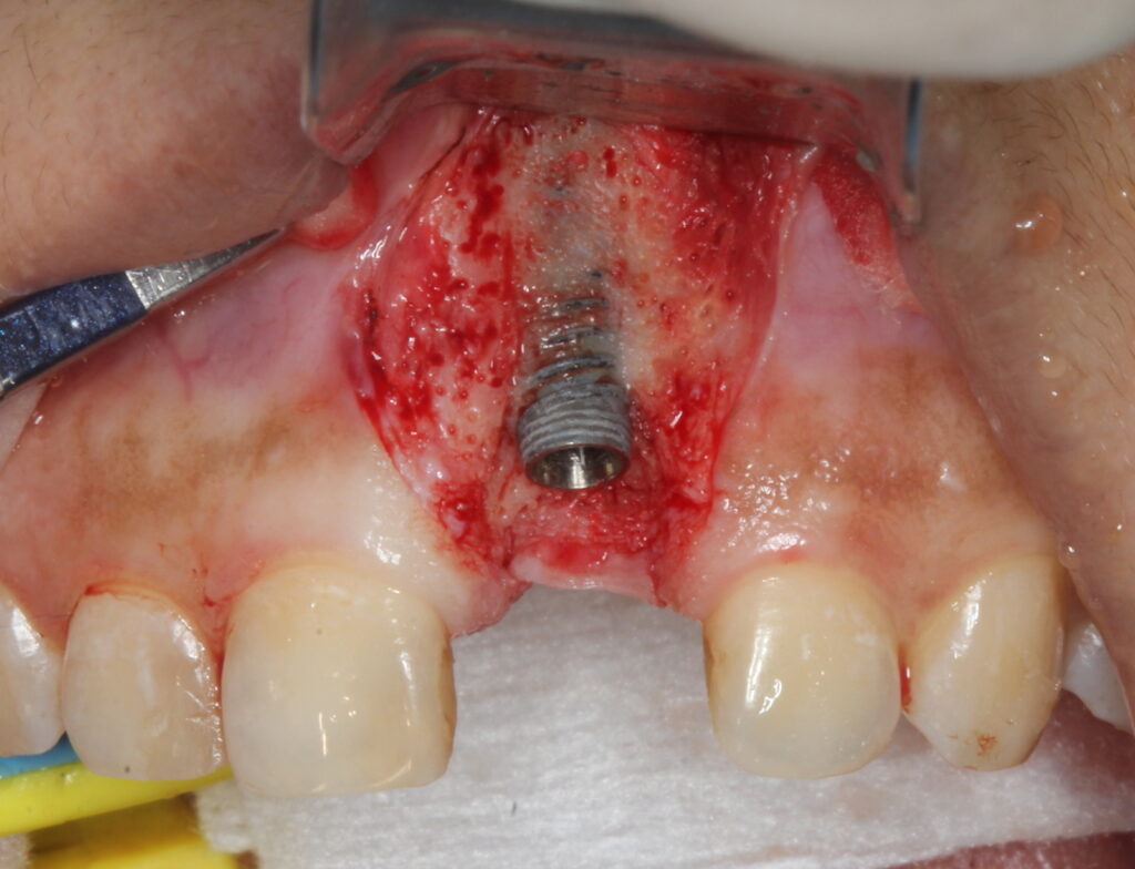 peri-implantitus