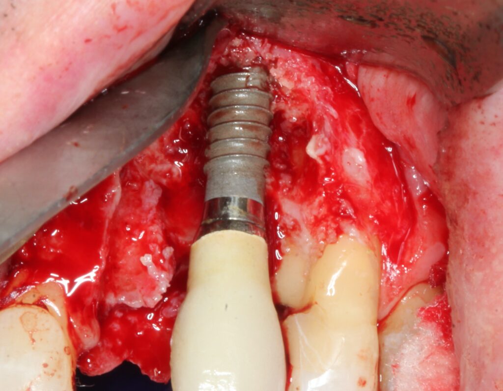 peri-implantitis