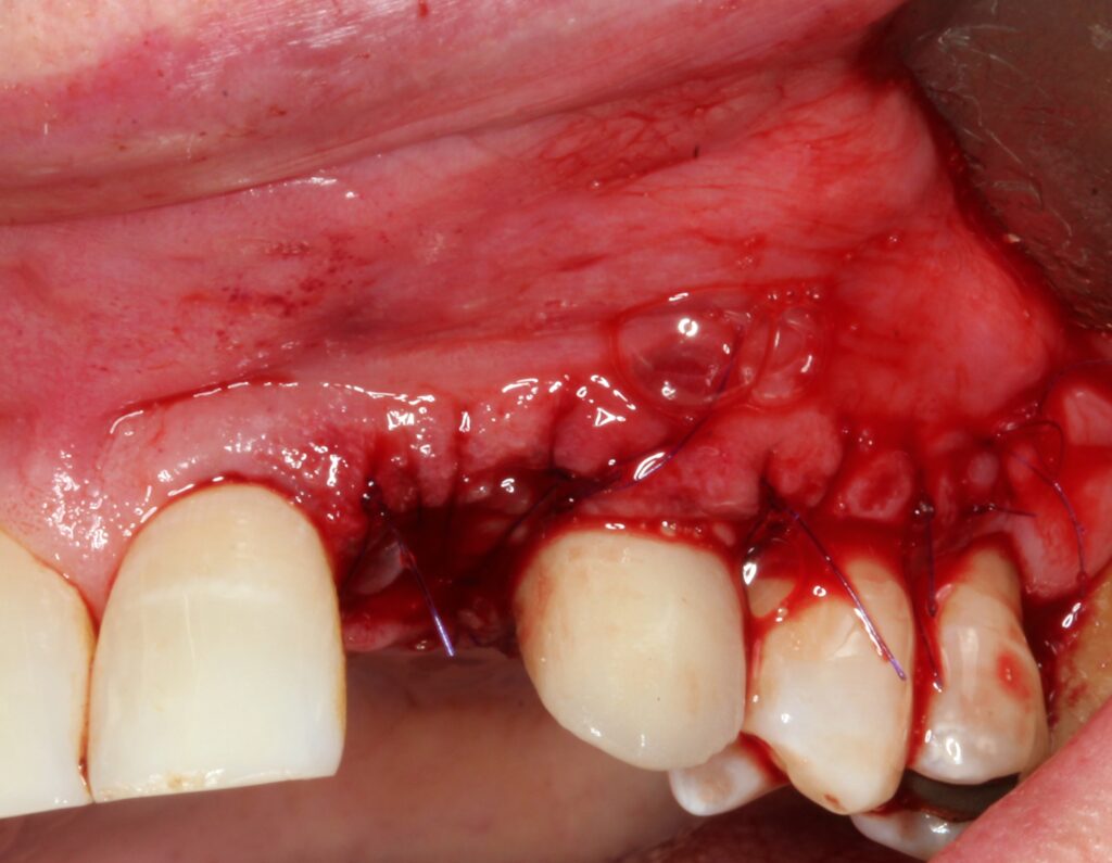 peri-implantitis