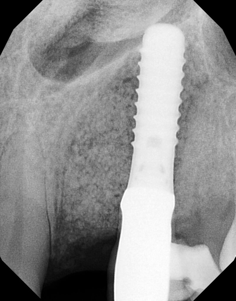 peri-implantitis