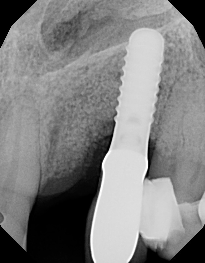 peri-implantitis