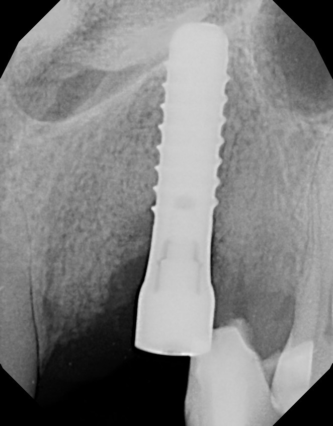 peri-implantitis