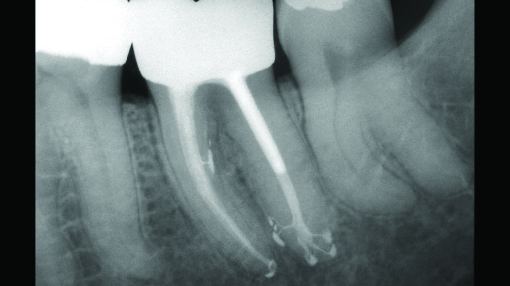 endodontic