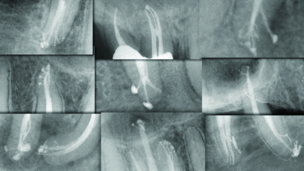 endodontic