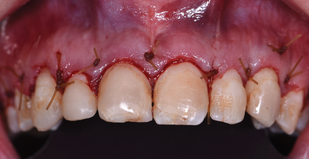 aesthetic crown lengthening