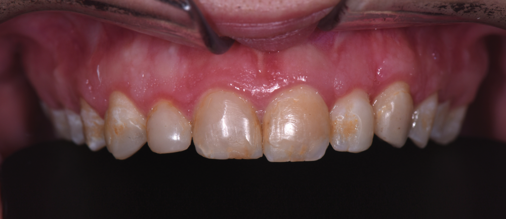 aesthetic crown lengthening