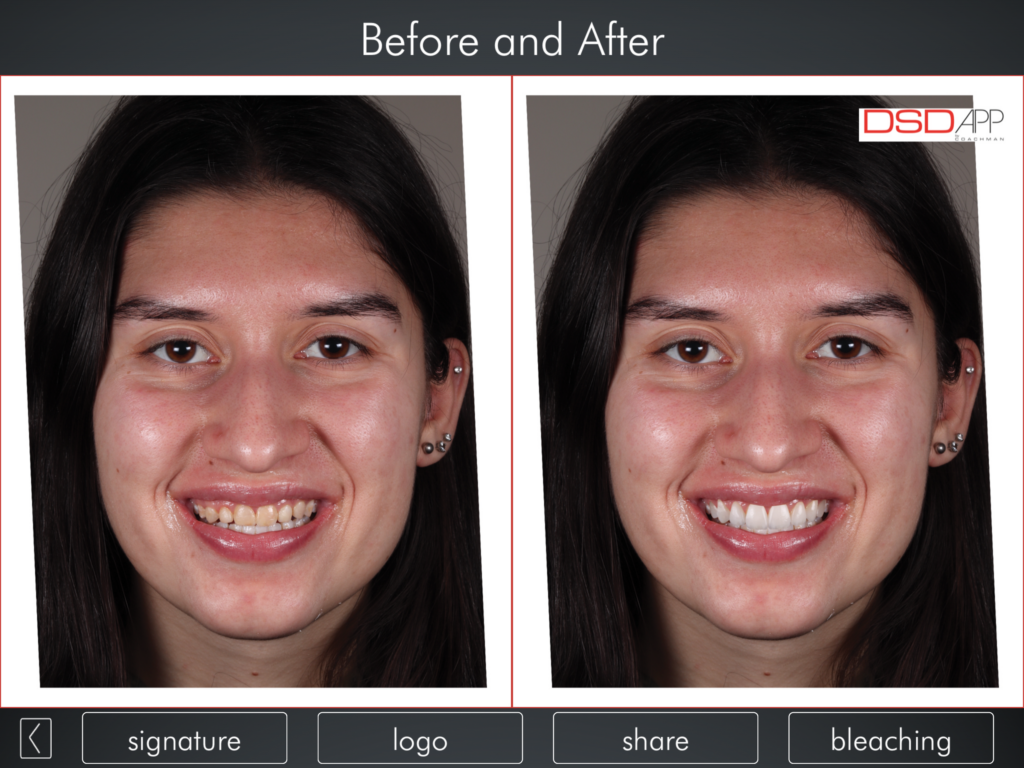 aesthetic crown lengthening