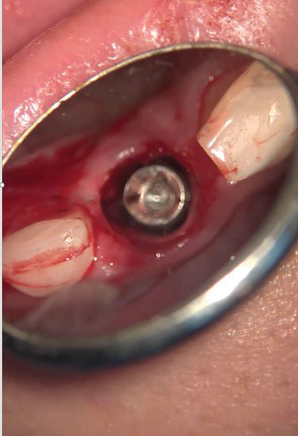 immediate implant placement