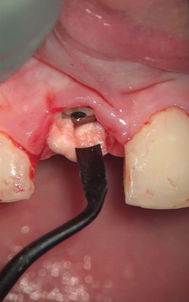 immediate implant placement