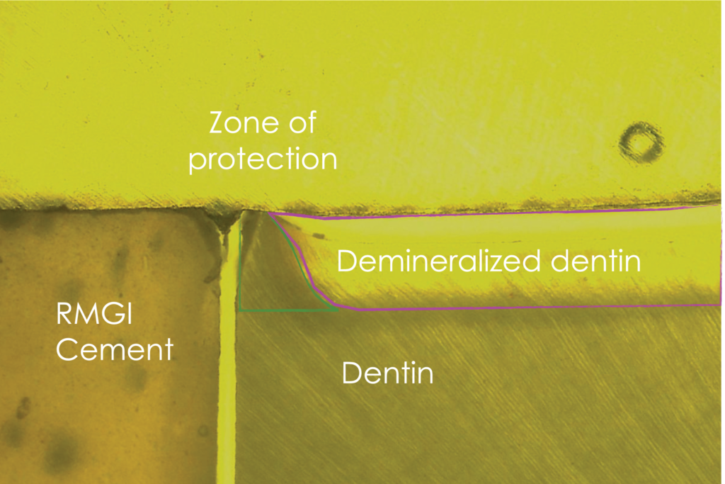 ceramic restorations