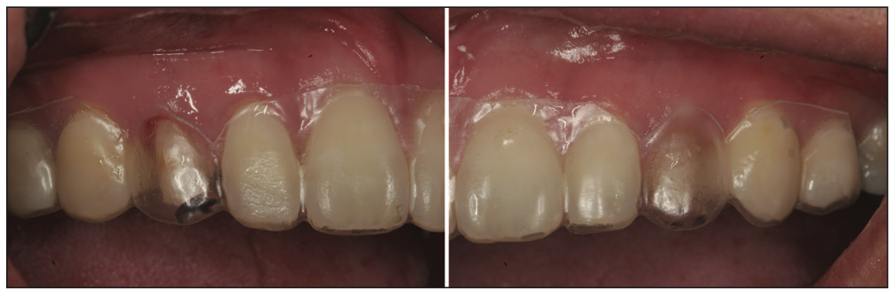 deciduous canines