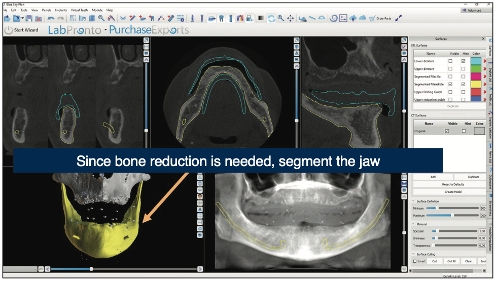 bone reduction