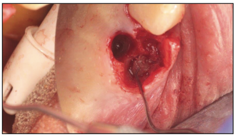 extraction complications
