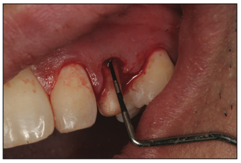 deciduous canines