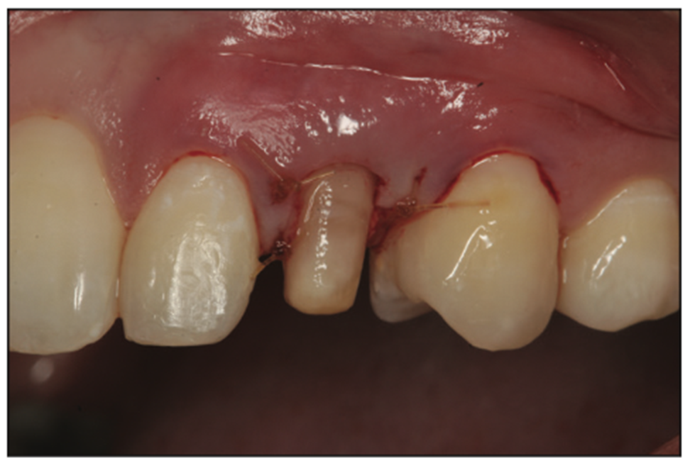 deciduous canines