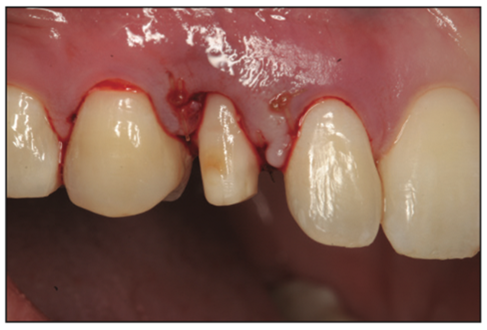 deciduous canines