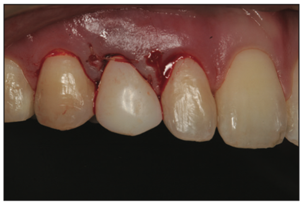deciduous canines