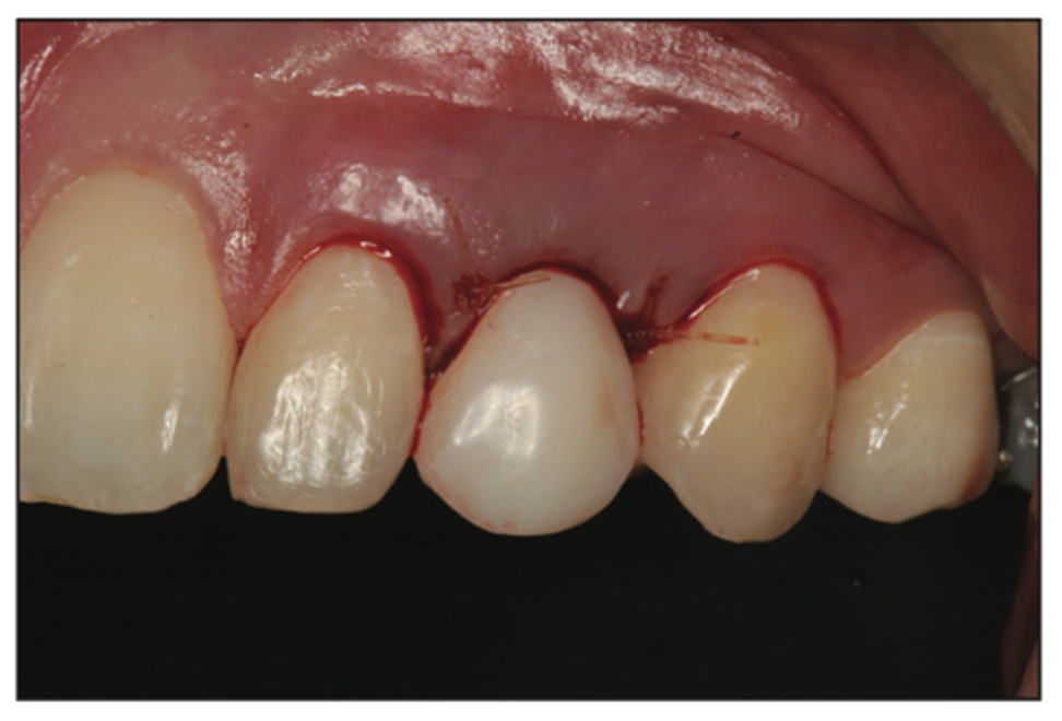 deciduous canines