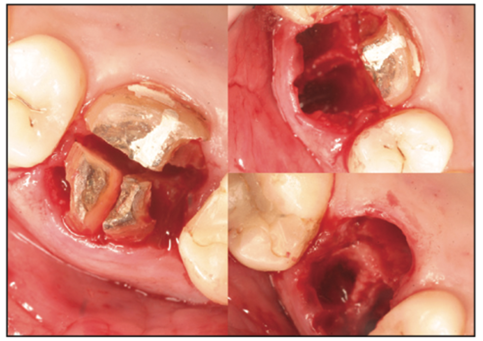 extraction complications