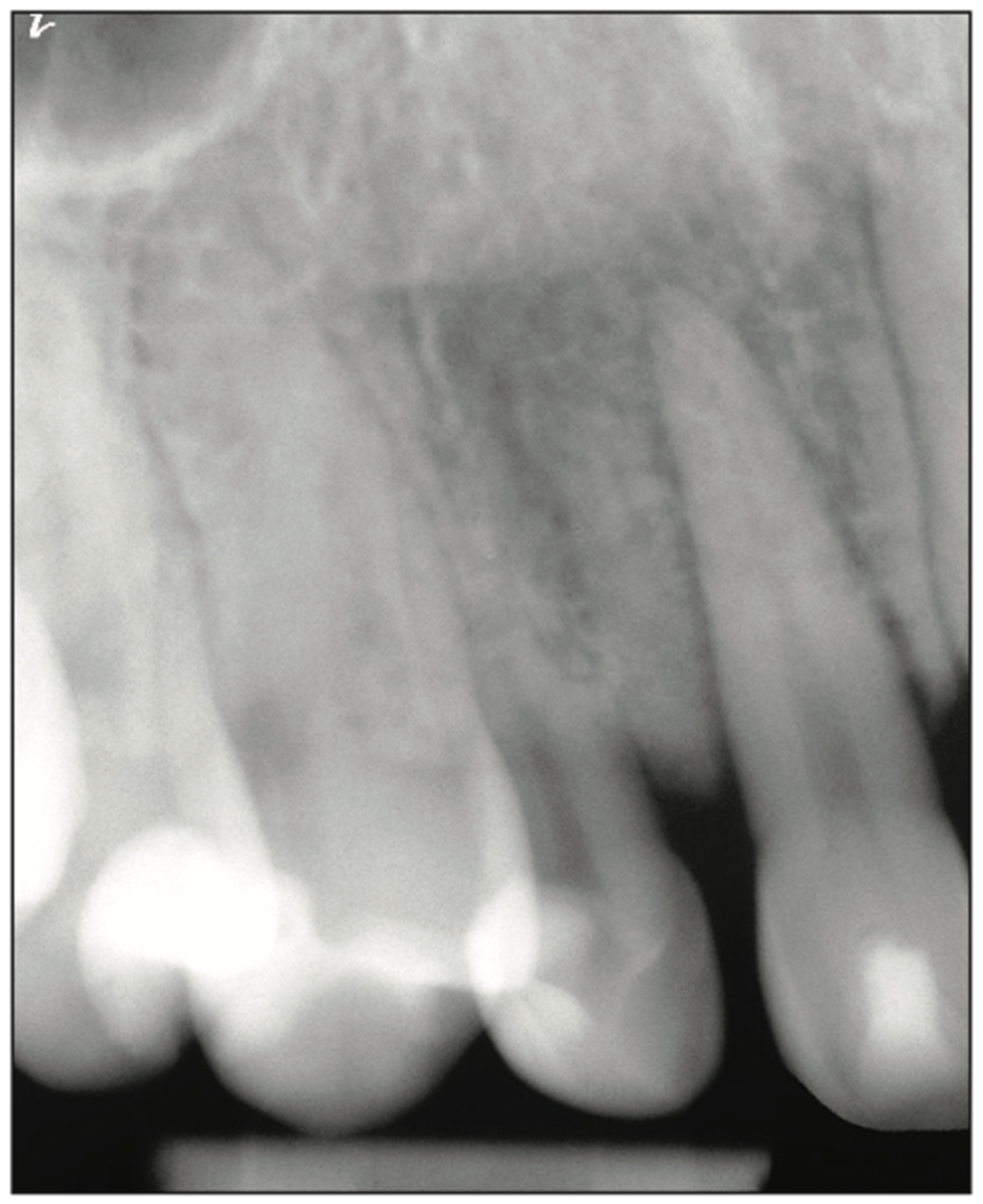 deciduous canines