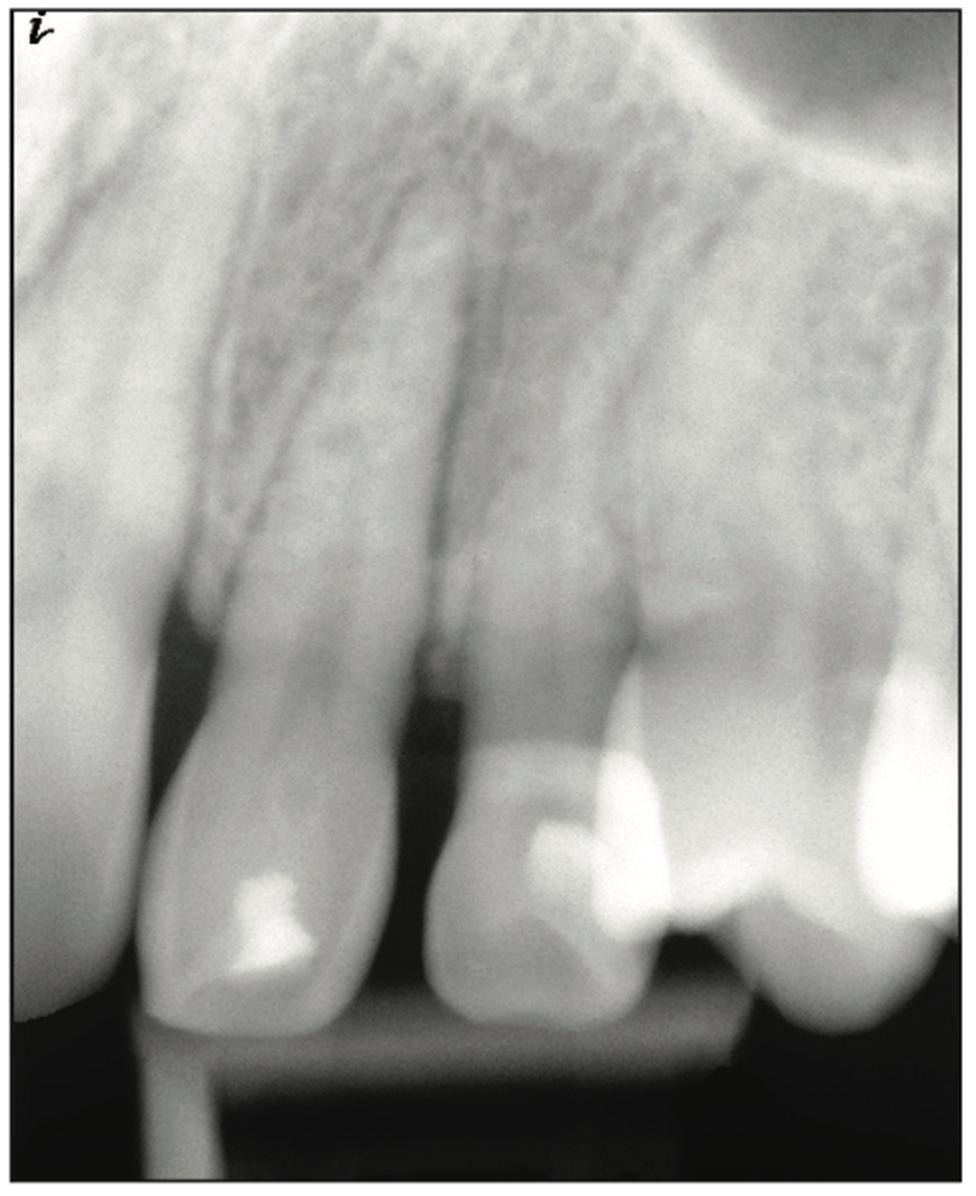 deciduous canines