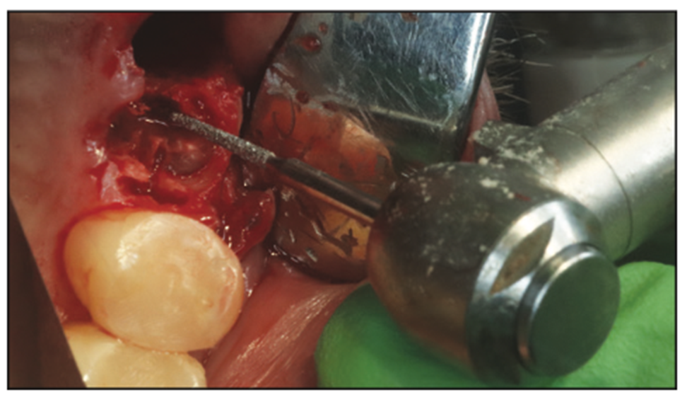 extraction complications