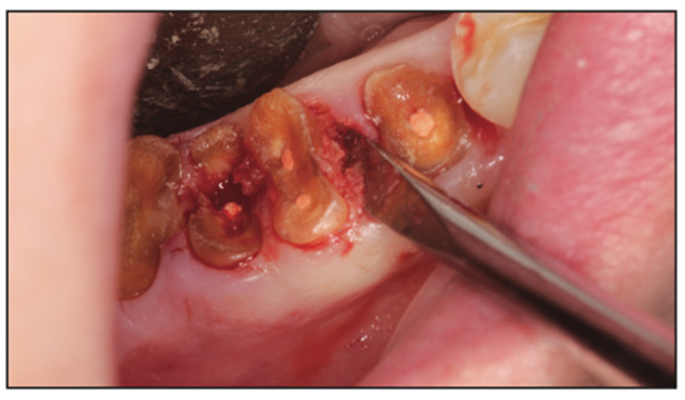 extraction complications