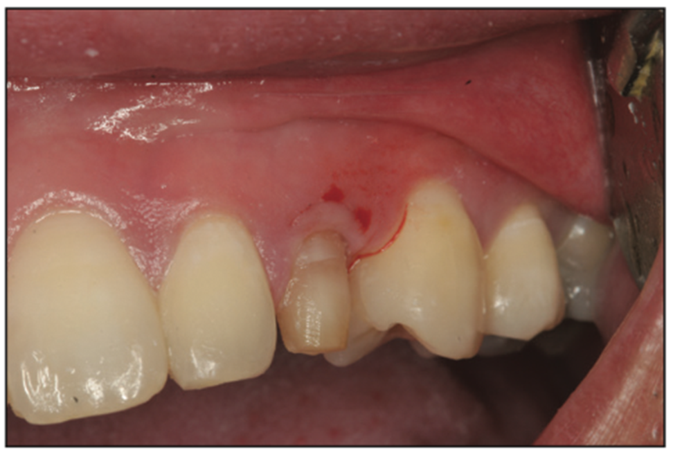 deciduous canines