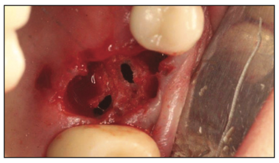 extraction complications