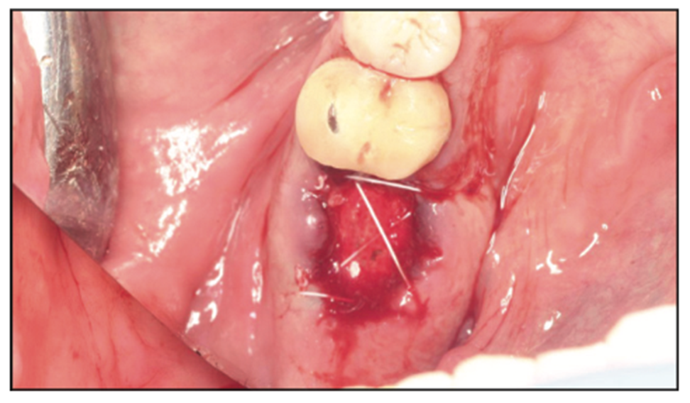 extraction complications