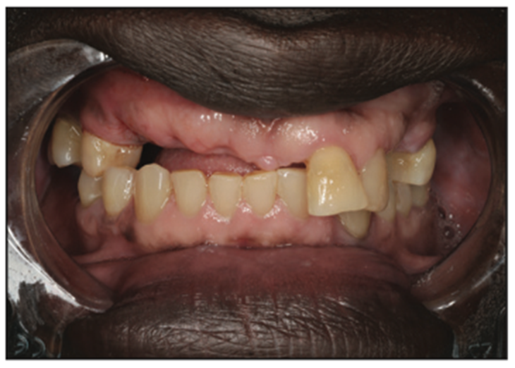 dental impressions