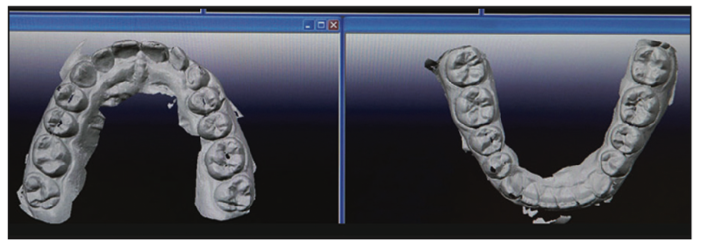 dental impressions