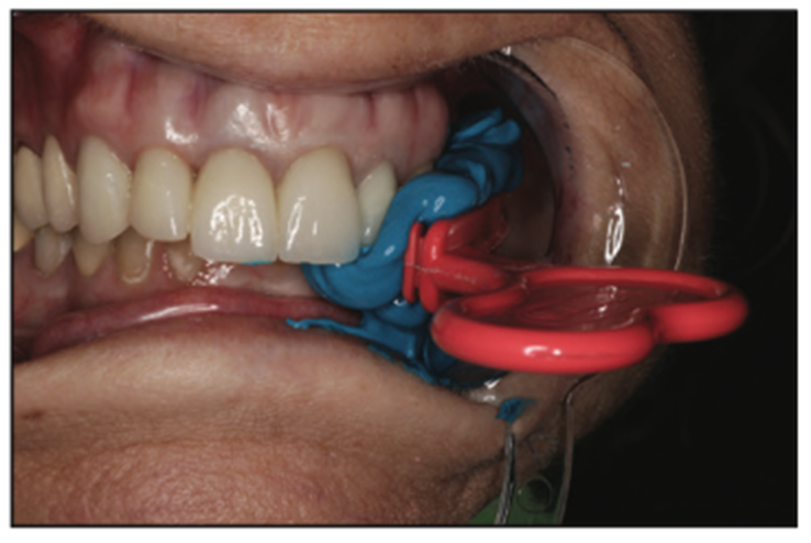 dental impressions