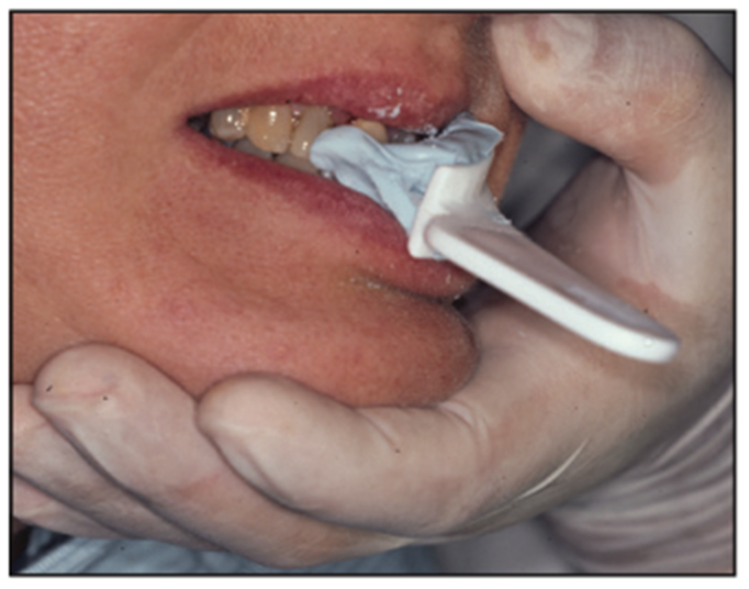 dental impressions