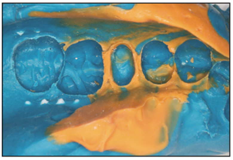 dental impressions