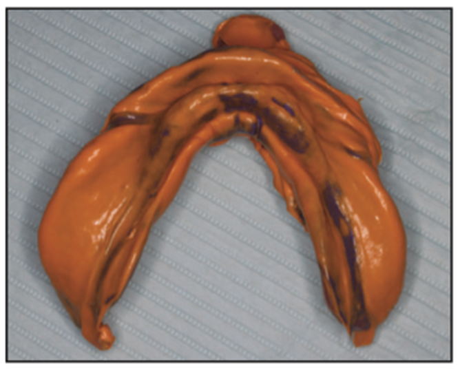 dental impressions