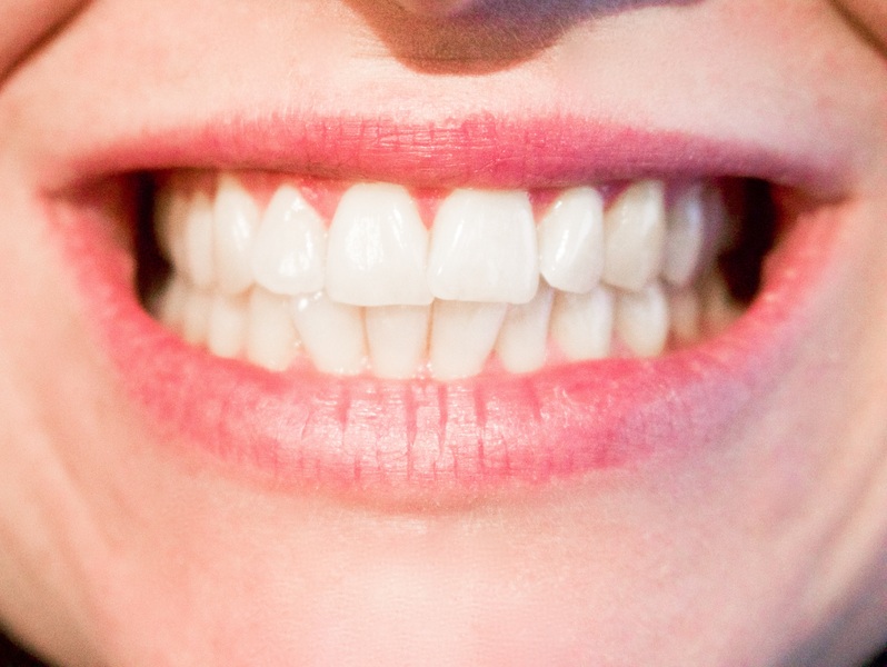 teeth stains