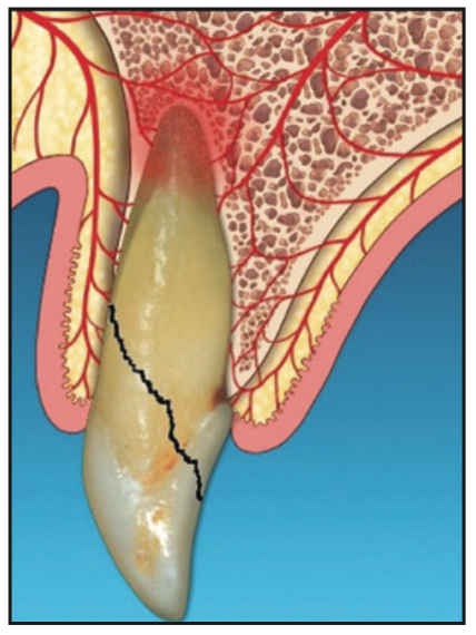 Laser-assisted socket grafting
