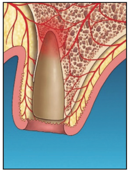 laser-assisted socket grafting